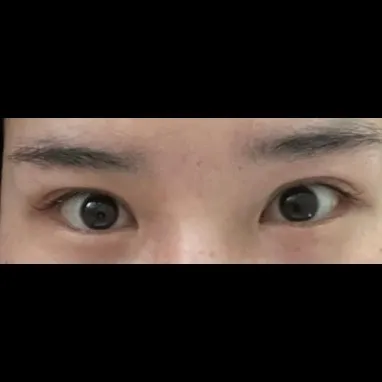 Revision ptosis correction — Afternoon Plastic Surgery 2