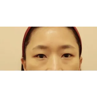 Incisional Double Eyelid Surgery, Ptosis Correction, Lower Eyelid Fat Repositioning 1