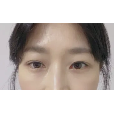 Incisional Double Eyelid Surgery, Ptosis Correction, Lower Eyelid Fat Repositioning — Afternoon Plastic Surgery 3