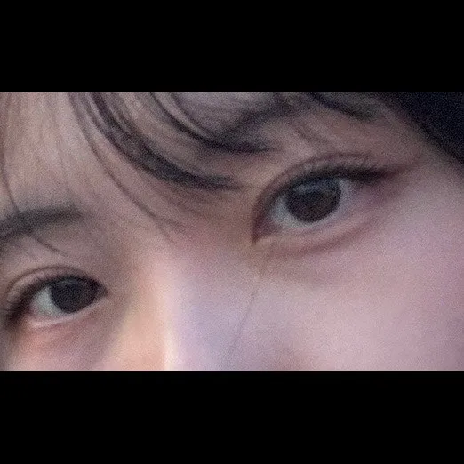 Revision ptosis correction — Afternoon Plastic Surgery 2