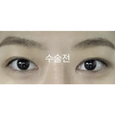Ptosis Correction, Non-incisional double eyelid surgery 1