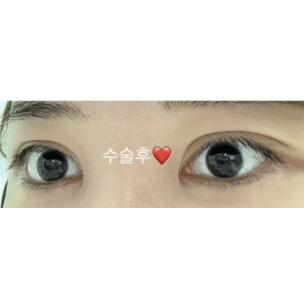 Ptosis Correction, Non-incisional double eyelid surgery 2