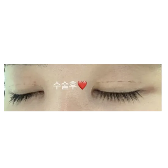 Ptosis Correction, Non-incisional double eyelid surgery — Afternoon Plastic Surgery 3
