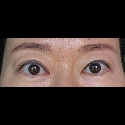 Epicanthoplasty Revision (Reconstruction) 1