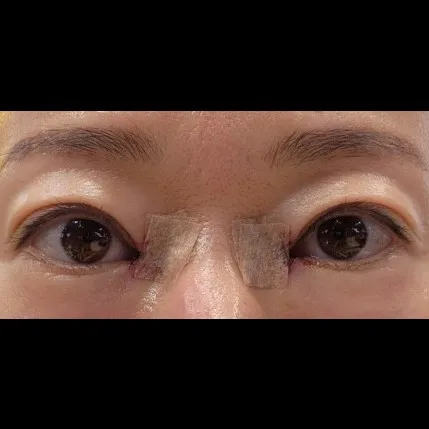 Epicanthoplasty Revision (Reconstruction) 2