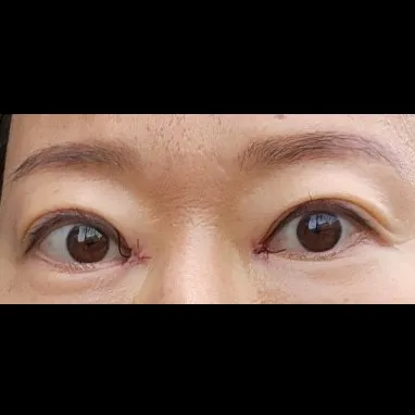Epicanthoplasty Revision (Reconstruction) — Afternoon Plastic Surgery 3