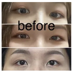Non-incisional double eyelid surgery, Ptosis Correction, Epicanthoplasty, Lower Eyelid Fat Repositioning — Afternoon Plastic Surgery 1