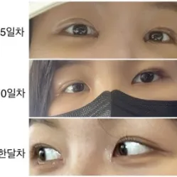 Non-incisional double eyelid surgery, Ptosis Correction, Epicanthoplasty, Lower Eyelid Fat Repositioning 2