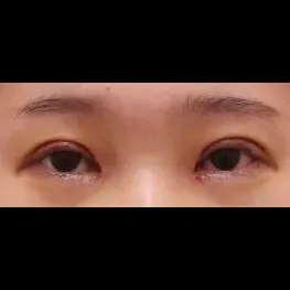 Incisional Double Eyelid Surgery — Afternoon Plastic Surgery 2
