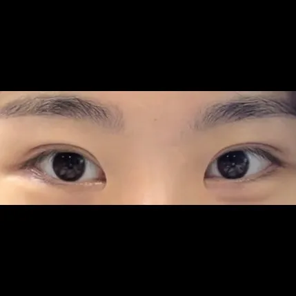 Revision ptosis correction — Afternoon Plastic Surgery 2