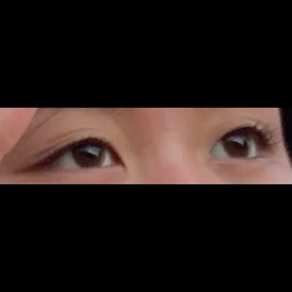 Non-incisional double eyelid surgery — Afternoon Plastic Surgery 1