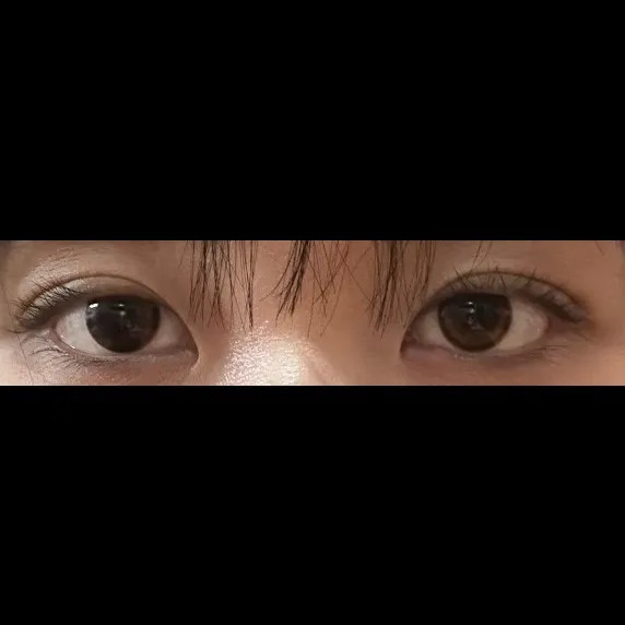Non-incisional double eyelid surgery — Afternoon Plastic Surgery 2
