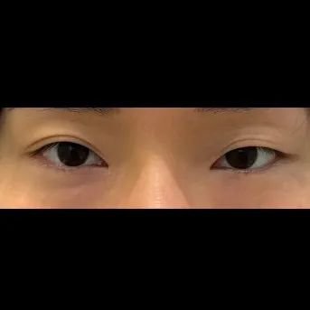 Ptosis Correction, Lateral canthoplasty 1