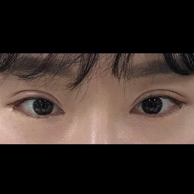 上睑下垂, 开外眼角 — Afternoon Plastic Surgery 2