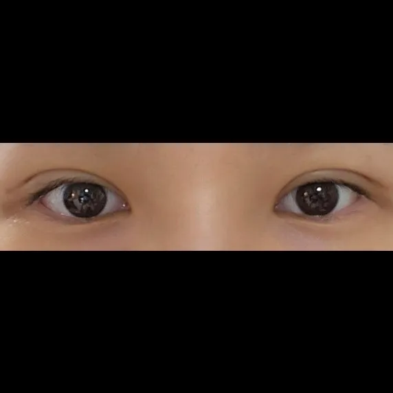 Incisional Double Eyelid Surgery — Afternoon Plastic Surgery 2