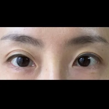 Revision ptosis correction, Lower Eyelid Fat Repositioning — Afternoon Plastic Surgery 1