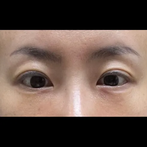 Revision ptosis correction, Lower Eyelid Fat Repositioning 2