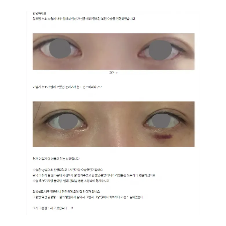 Epicanthoplasty Revision (Reconstruction) 1