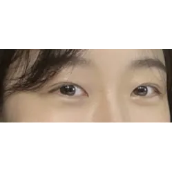 Ptosis Correction, Non-incisional double eyelid surgery — Afternoon Plastic Surgery 2
