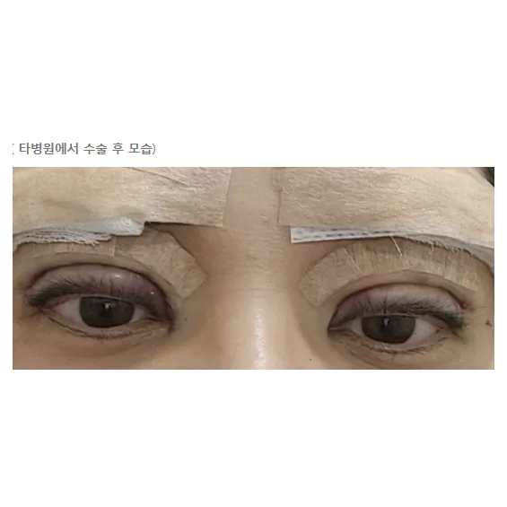 Revision ptosis correction 1