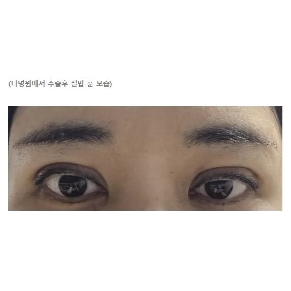 Revision ptosis correction 2