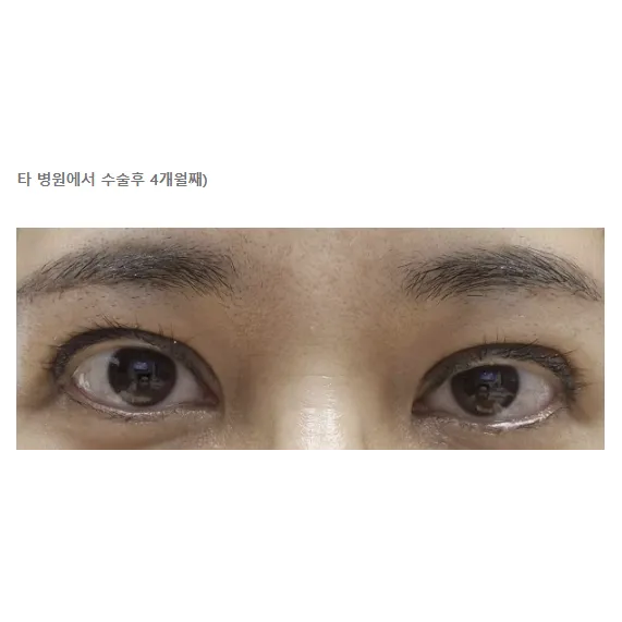 Revision ptosis correction — Afternoon Plastic Surgery 3