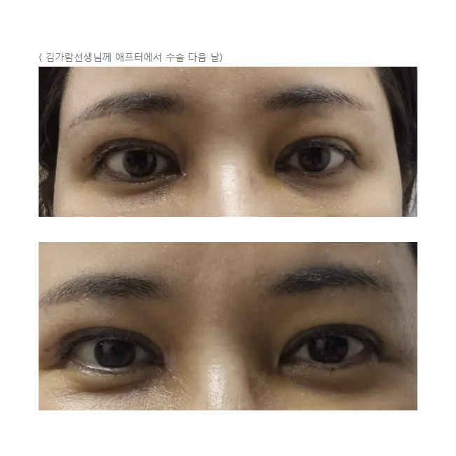Revision ptosis correction — Afternoon Plastic Surgery 4