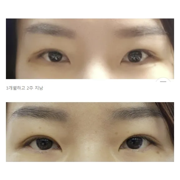 Incisional Double Eyelid Surgery, Revision ptosis correction — Afternoon Plastic Surgery 2