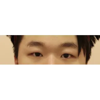 Incisional Double Eyelid Surgery, Ptosis Correction 1