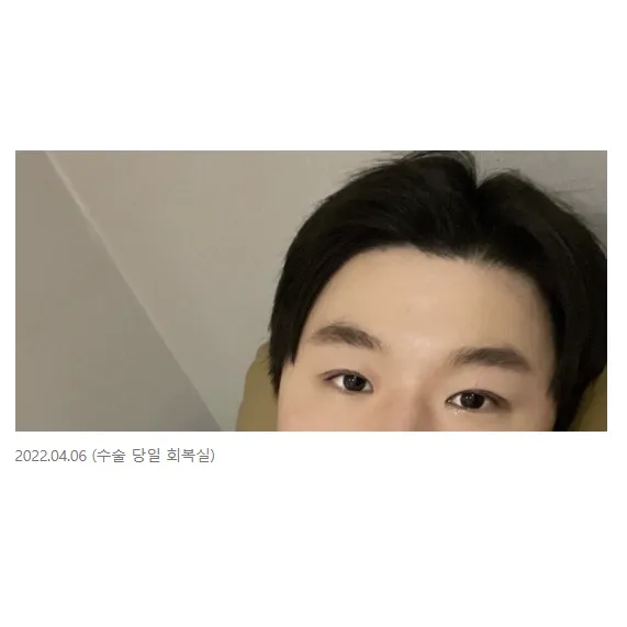 Incisional Double Eyelid Surgery, Ptosis Correction 2