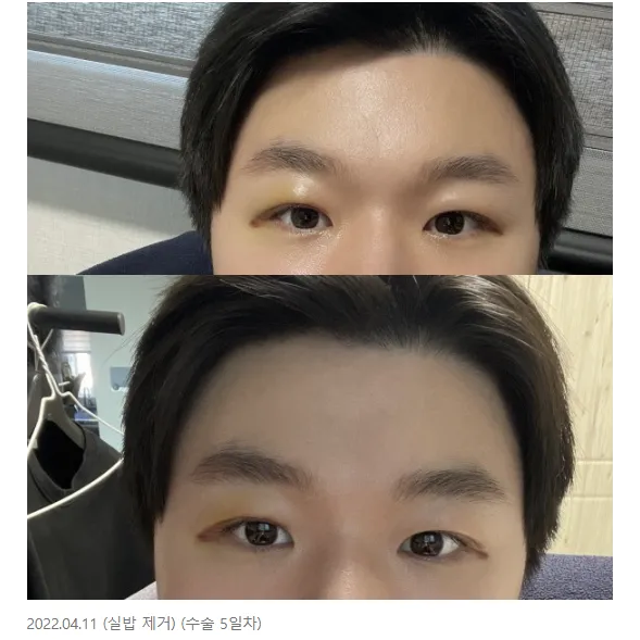 Incisional Double Eyelid Surgery, Ptosis Correction — Afternoon Plastic Surgery 3
