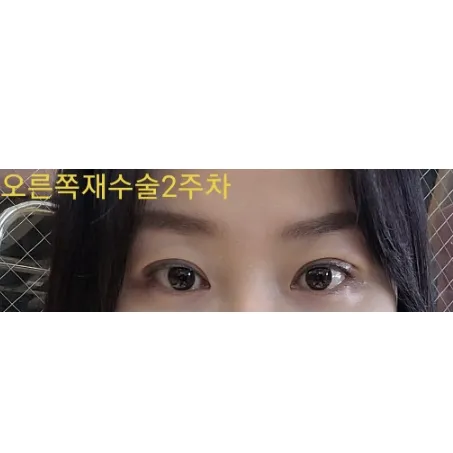 Non-incisional double eyelid surgery — Afternoon Plastic Surgery 2