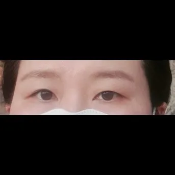Ptosis Correction, Incisional Double Eyelid Surgery 1
