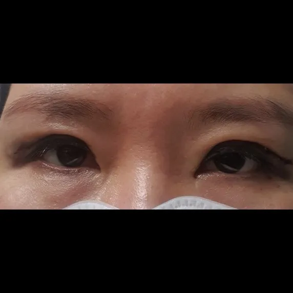 Ptosis Correction, Incisional Double Eyelid Surgery — Afternoon Plastic Surgery 2