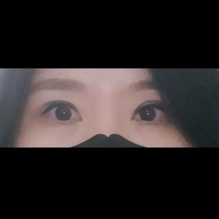 Ptosis Correction, Incisional Double Eyelid Surgery — Afternoon Plastic Surgery 3