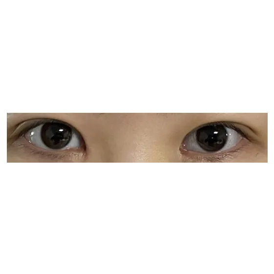 Incisional Double Eyelid Surgery, Revision ptosis correction — Afternoon Plastic Surgery 2