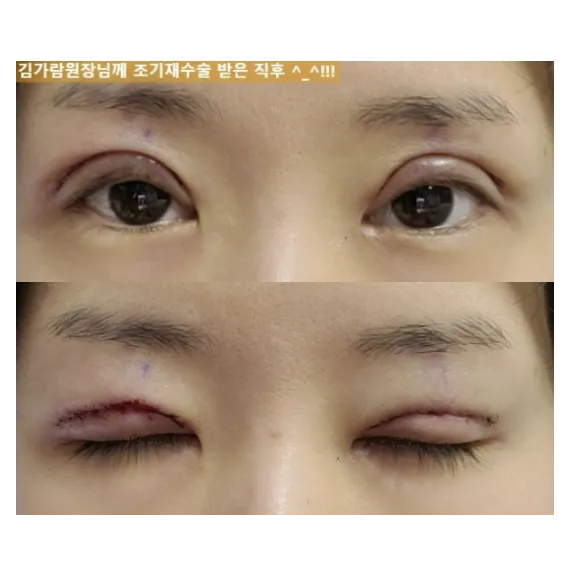 Revision ptosis correction, Incisional Double Eyelid Surgery — Afternoon Plastic Surgery 2
