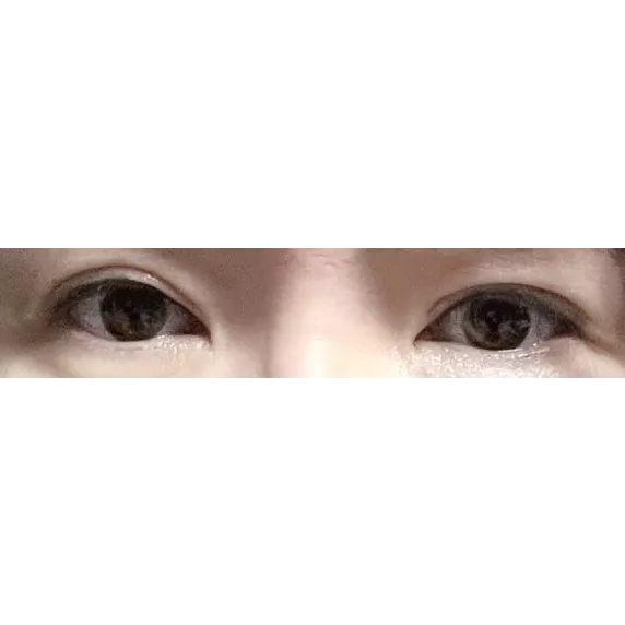 Revision ptosis correction, Incisional Double Eyelid Surgery, Mini Facelift — Afternoon Plastic Surgery 1
