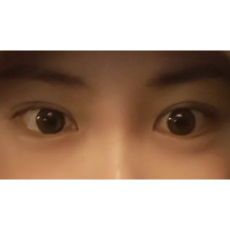 Non-incisional double eyelid surgery, Ptosis Correction — Afternoon Plastic Surgery 2