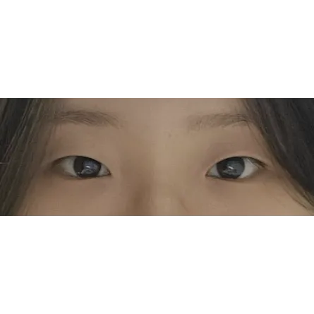 Incisional Double Eyelid Surgery, Ptosis Correction, Epicanthoplasty 1