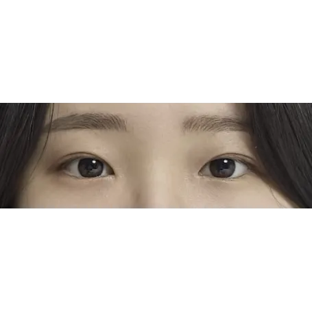 Incisional Double Eyelid Surgery, Ptosis Correction, Epicanthoplasty 2