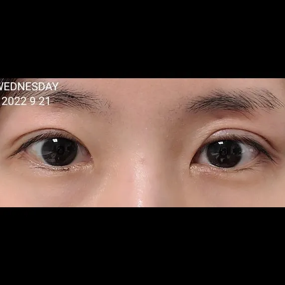 Revision ptosis correction 1