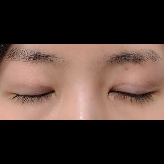 Revision ptosis correction — Afternoon Plastic Surgery 2