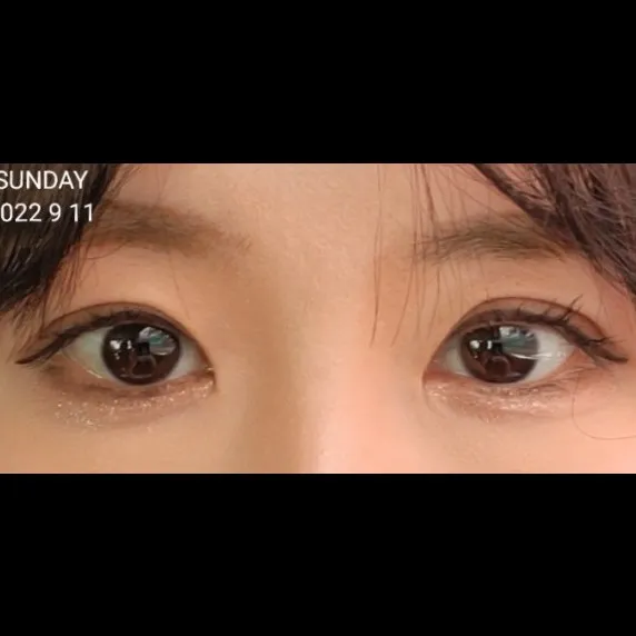 Revision ptosis correction — Afternoon Plastic Surgery 3
