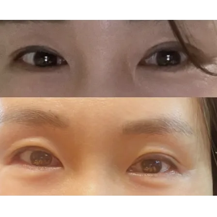 Incisional Double Eyelid Surgery, Revision ptosis correction — Afternoon Plastic Surgery 2