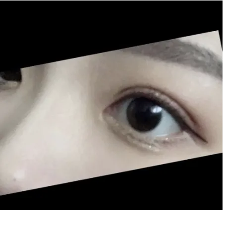 Non-incisional double eyelid surgery, Ptosis Correction — Afternoon Plastic Surgery 2