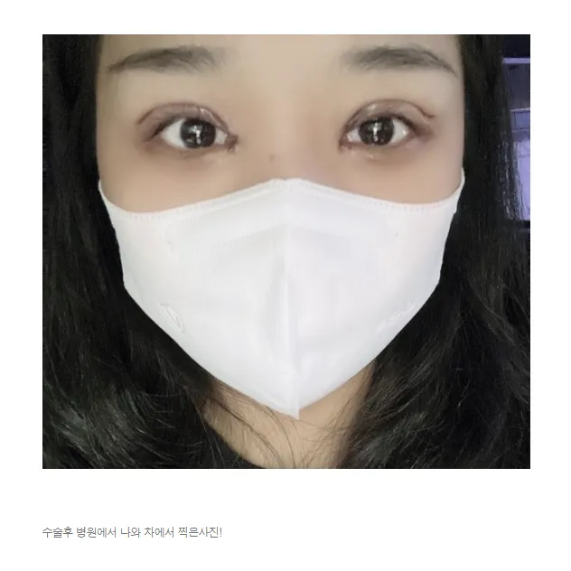 Revision ptosis correction — Afternoon Plastic Surgery 2