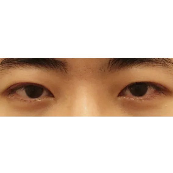Ptosis Correction, Incisional Double Eyelid Surgery — Afternoon Plastic Surgery 2