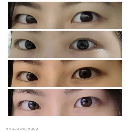 Non-incisional double eyelid surgery 1