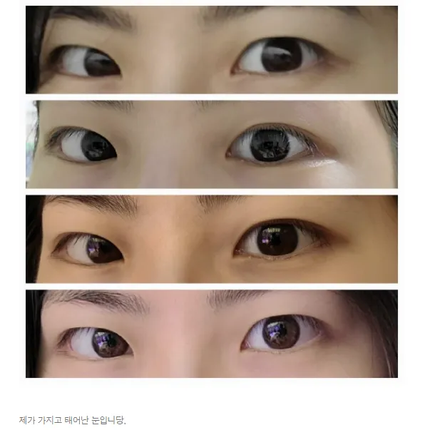 Non-incisional double eyelid surgery 1